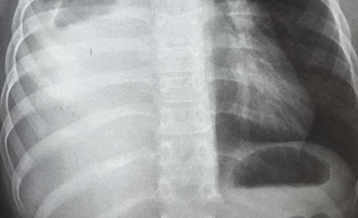 MEDIASTINO