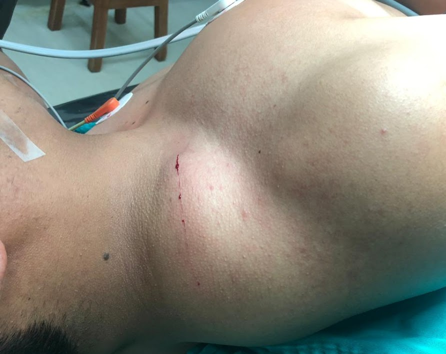 foto paciente hidatidosis