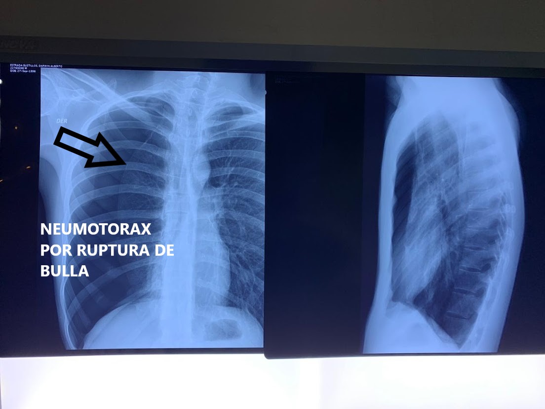 neumotorax derecho por ruptura de bulla con texto