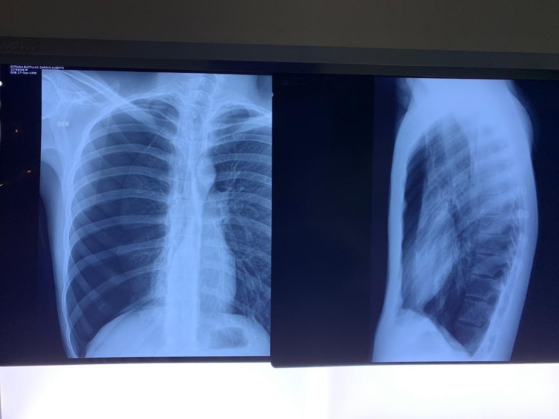neumotorax derecho por ruptura de bulla
