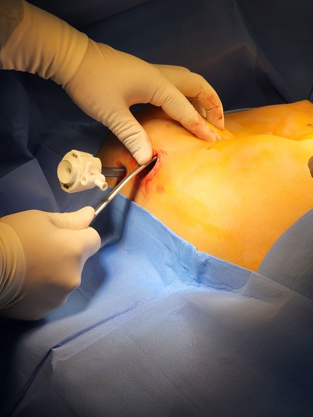 pectus 2