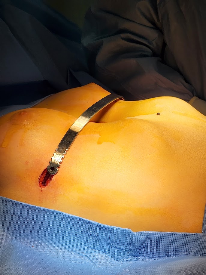 pectus preop