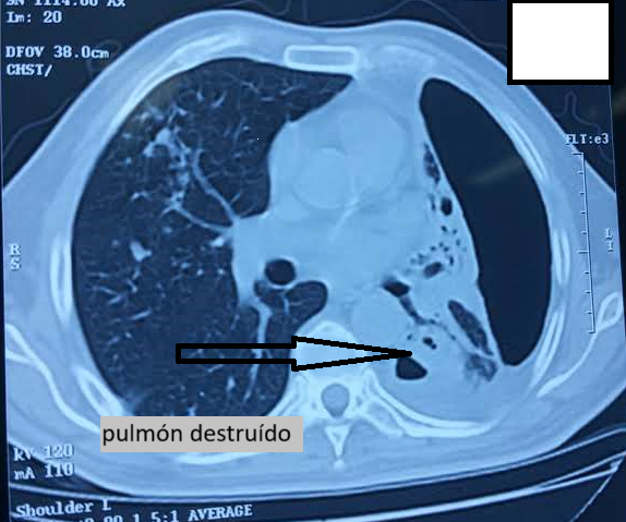 pulmón destrido