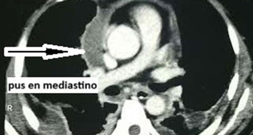 pus-en-el-mediastino