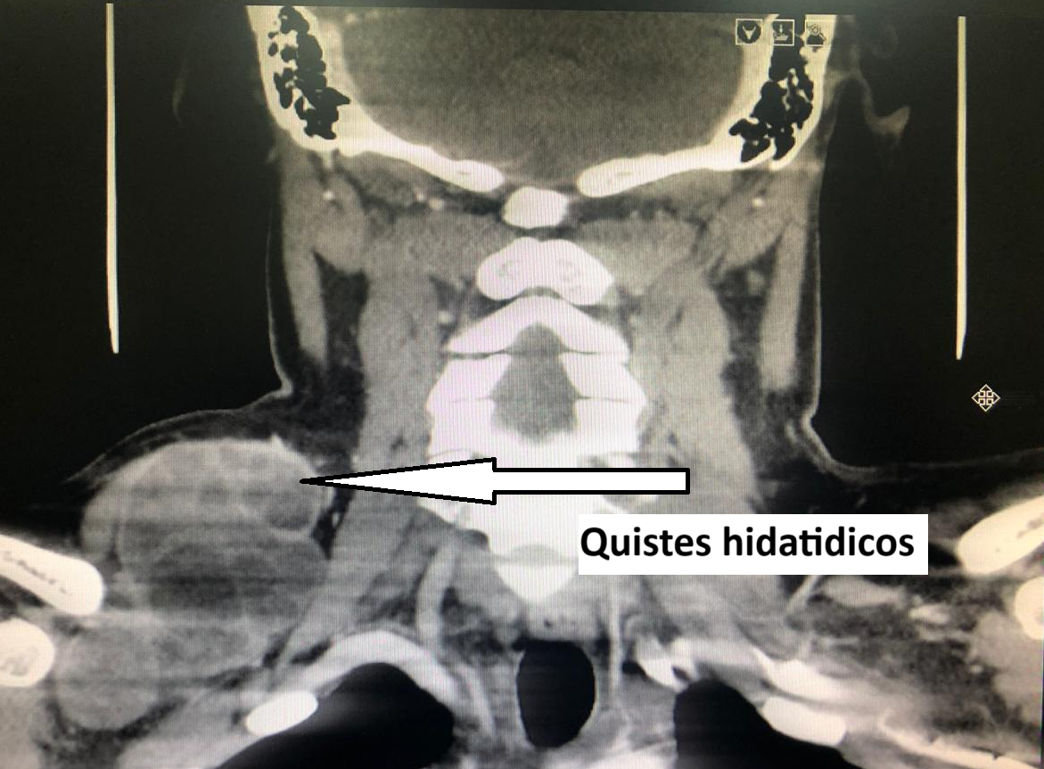 quistes hidatidicos
