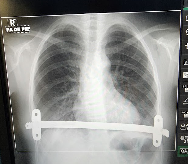 radiografia pectus pos operatoria