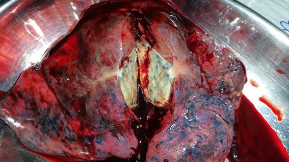 tuberculoma-pulmonar