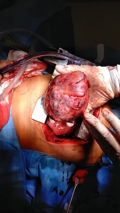 tumor fibroso solitario